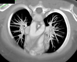 Double Aortic Arch With Mirror Branching - CTisus CT Scan