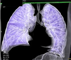 Airway Narrowing Due to Double Arch - CTisus CT Scan