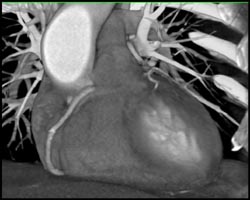 LAD Off RCA-see Sequence - CTisus CT Scan