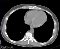 Myocardial Calcification Secondary to CRF - CTisus CT Scan
