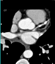 Plaque in LAD With Less Than 50 Percent Stenosis - CTisus CT Scan