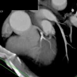 Extensive Plaque in Left Main and LAD - CTisus CT Scan