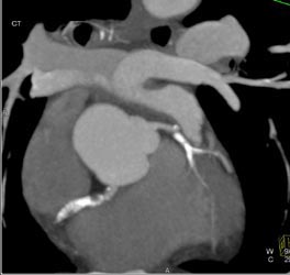 Soft Plaque RCA With Stenosis - CTisus CT Scan