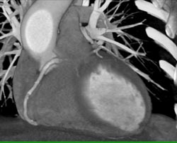 Left Main Off Right Coronary Artery - CTisus CT Scan