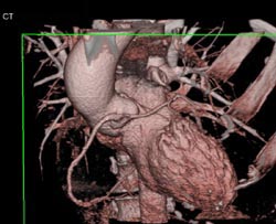 Left Main Off Right Coronary Artery - CTisus CT Scan