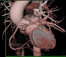 Left Main Off Right Coronary Artery - CTisus CT Scan