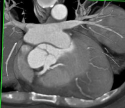 Left Main Off Right Coronary Artery - CTisus CT Scan