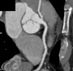 Left Main Off Right Coronary Artery - CTisus CT Scan