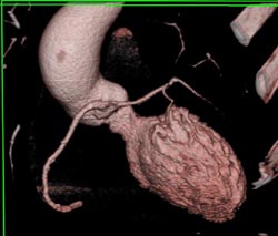 Left Main Off Right Coronary Artery - CTisus CT Scan