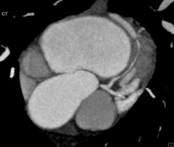 Normal LAD - CTisus CT Scan