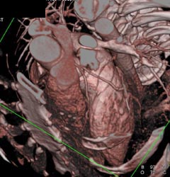 Normal LAD - CTisus CT Scan