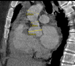 Supravalvular Aortic Stenosis- Williams Syndrome - CTisus CT Scan