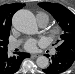 Motion Artifact Creates Two Coronary Arteries - CTisus CT Scan