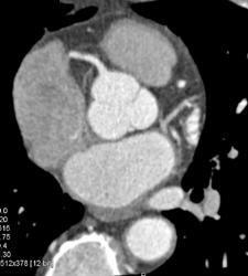 Ramus Intermedius - CTisus CT Scan