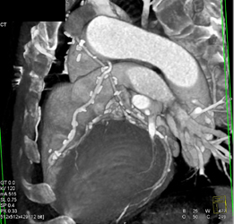 Patent Bypass Grafts - CTisus CT Scan