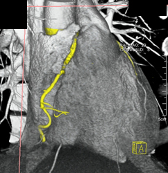 Normal RCA - CTisus CT Scan