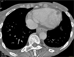 LV Thrombus - CTisus CT Scan