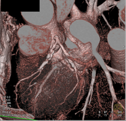 Diseased LAD Circumflex Artery (CX) and RCA - CTisus CT Scan