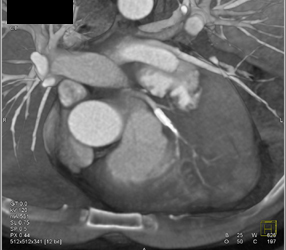 Patent LAD Stent - CTisus CT Scan