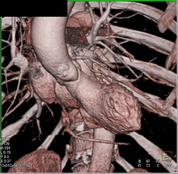 Nice Segmentation of Left Ventricle - CTisus CT Scan