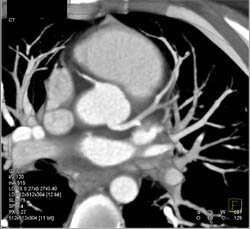 Coronary Arteries Normal in Patient With Lung Cancer and Adrenal Metastases - CTisus CT Scan