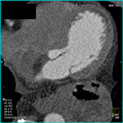 Patent Stent in LAD - CTisus CT Scan