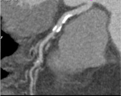 Diseased LAD - CTisus CT Scan