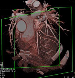 Normal Left Coronary Artery Anatomy With Various Shading Models - CTisus CT Scan