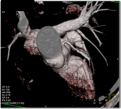 Stent in LAD - CTisus CT Scan