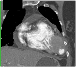 Pericardial Effusion and Lv Aneurysm - CTisus CT Scan