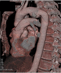 Ductus Aneurysm - CTisus CT Scan