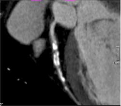 Near Occlusion of LAD - CTisus CT Scan