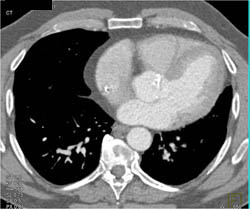 Aortic Calcifications - CTisus CT Scan