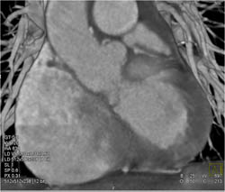 Dilated Left Main Coronary Artery S/P Reimplantation - CTisus CT Scan
