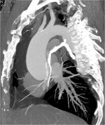 Bicuspid Valve - CTisus CT Scan