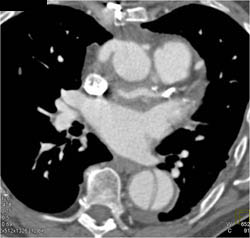 Cad With Dissection - CTisus CT Scan