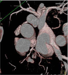 Plaque LAD - CTisus CT Scan