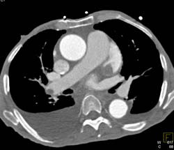 Clot in Atrial Appendage and Right Pulmonary Artery - CTisus CT Scan