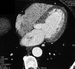 Left Atrial Thrombus - CTisus CT Scan
