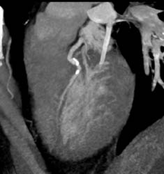 LAD Disease - CTisus CT Scan