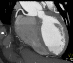 Normal RCA - CTisus CT Scan