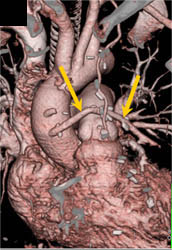 Bypass Grafts - CTisus CT Scan