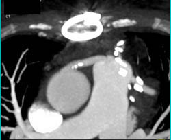 Bypass Grafts - CTisus CT Scan