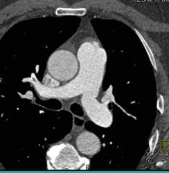 Dilated Main Pulmonary Artery - CTisus CT Scan