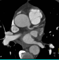 Minimal LAD Disease - CTisus CT Scan