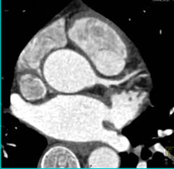 Plaque LAD - CTisus CT Scan