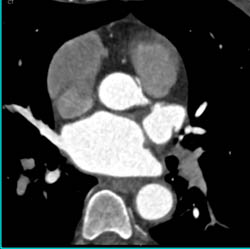 RCA Which Arises Off Left Cusp and Travels Between Aorta and Pulmonary Artery - CTisus CT Scan