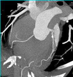 Calcified Plaque in LAD in Multiple Renderings - CTisus CT Scan