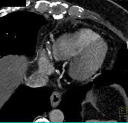 Occluded Native Coronary Arteries With Multiple Bypasses - CTisus CT Scan