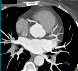 Calcified Plaque LAD - CTisus CT Scan